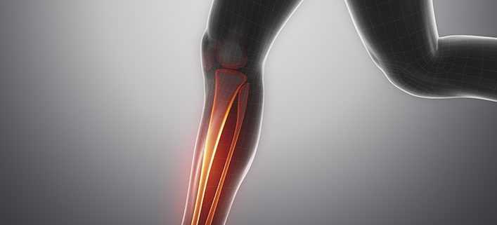 Knee Joint Osteoarthritis Stages Treatment Symptoms Physio Pretoria
