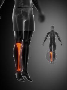Shin Splints, Shin pain with running: Pain in front of Shin - Physio