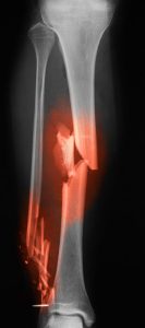 Bone fractures: Broken Collar bone fractures, Bone injury - Physio PTA