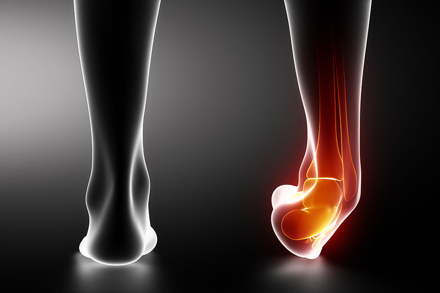 Sprained Ankle? Torn ankle ligaments, Ankle sprain Physio Pretoria