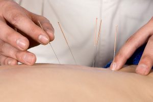 Acupuncture treatment Physio, Acupuncture Pretoria, Needling