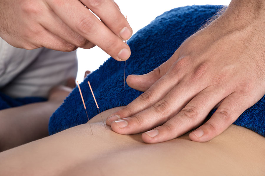 Acupuncture of the Lower Back