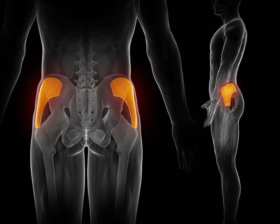 Gluteus Muscle Strain, Gluteal muscle strain