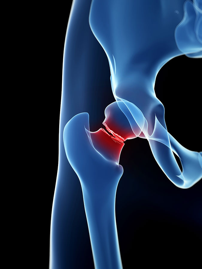 Hip Bursitis