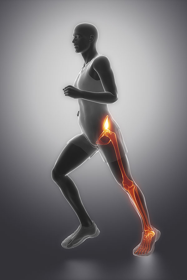 Piriformis Syndrome,