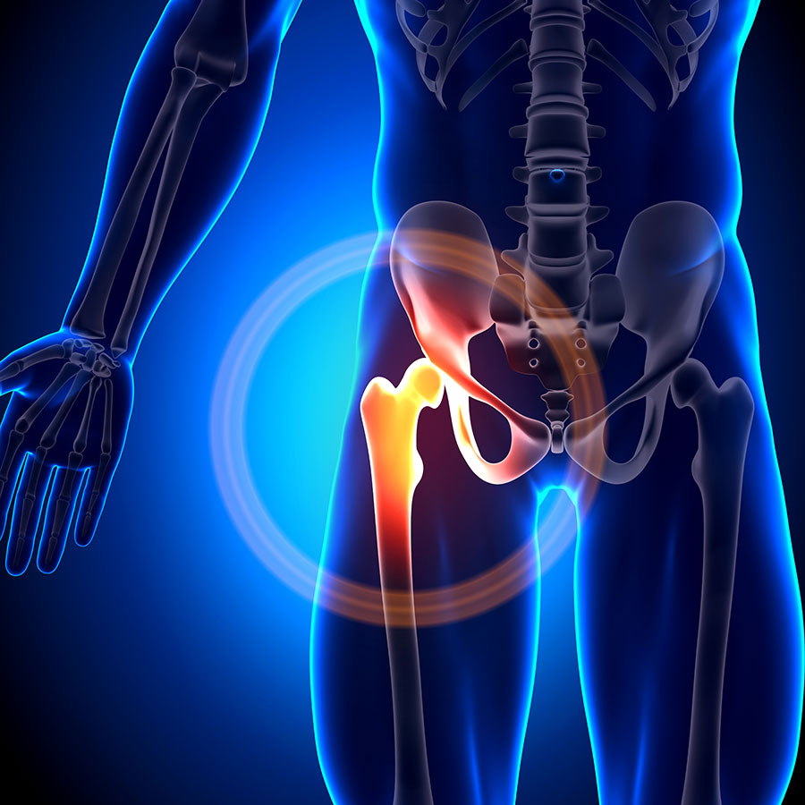Hip Osteoarthritis, Hip joint osteoarthritis, Hip joint arthritis, Osteoarthritis of the hip, hip arthritis pain
