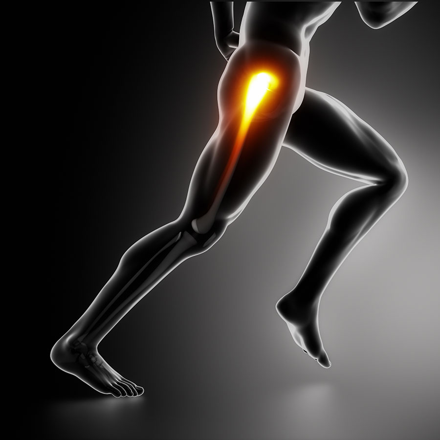 Bursitis in hip, hip bursitis pain, Trochanteric bursitis, hip bursitis pain