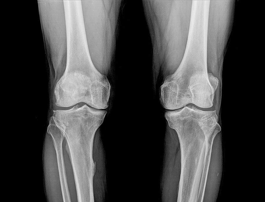 Knee joint X-rays, Normal_rear Total knee replacement