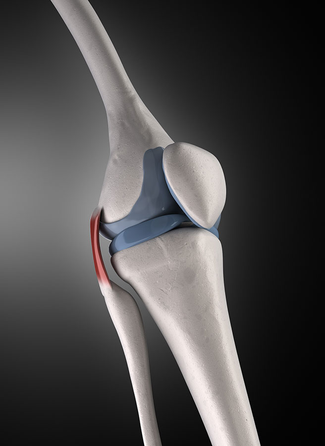 Lateral Colateral Ligament injury
