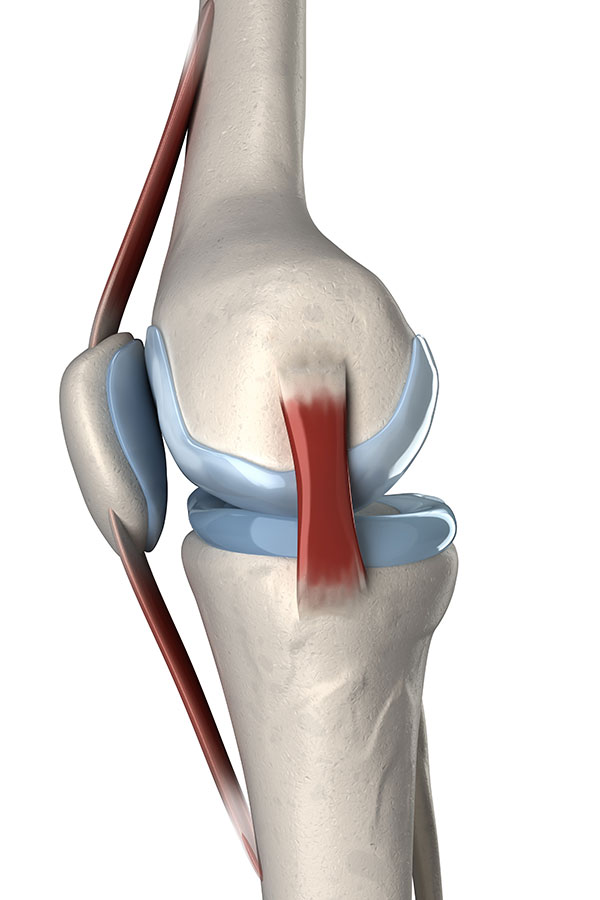 Medial Collateral Ligament injury, MCL injury, MCL Sprain, Knee ligament sprain Medial Collateral Ligament