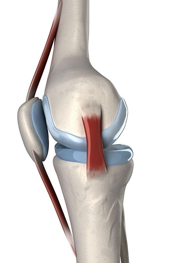 Dealing With & Treating Knee Pain from an MCL Injury