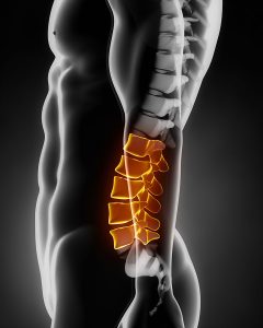 Lower back pain treatment and X-ray view of the side of Lumbar pain