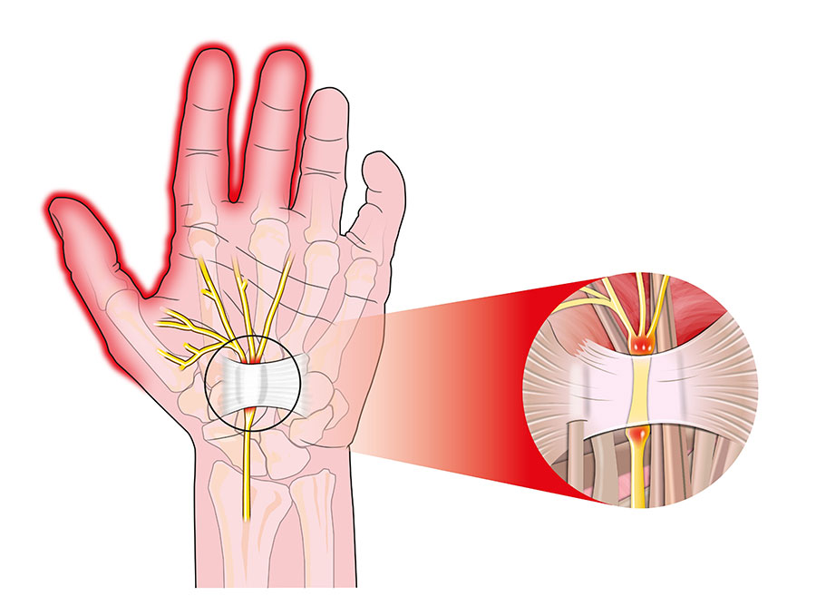 Nerve pain in Hand Causes & Symptoms of Nerve pain Hand therapist