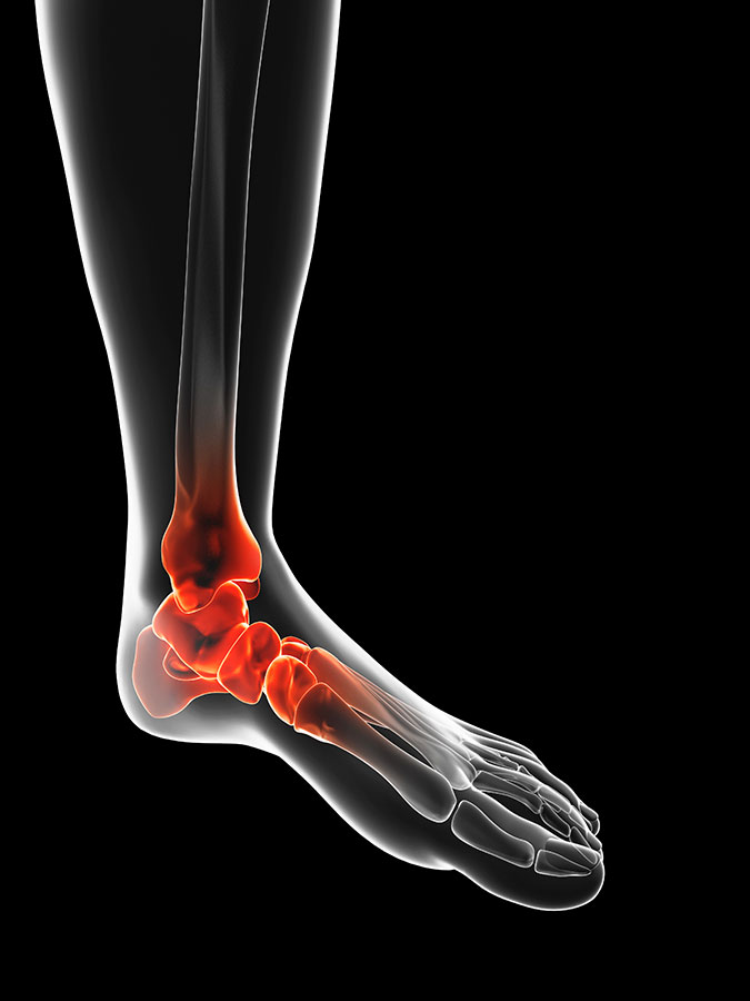 Ankle sprain, Lateral Ankle Ligament Sprain & tear (Ankle pain)