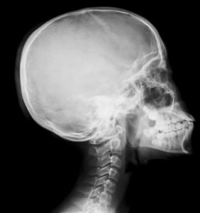 Scull and cervical (neck X-ray_side Neck Pain, Stiff Neck Muscles