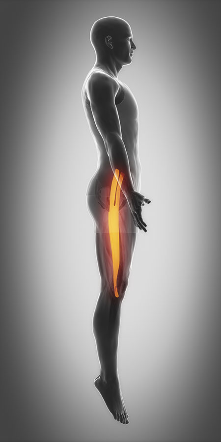 Hip Bursitis, Bursitis in hip, hip bursitis pain, Trochanteric bursitis, hip bursitis pain