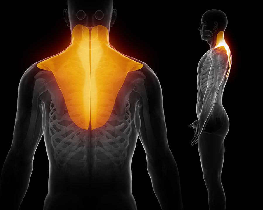 Muscle injury of the upper back