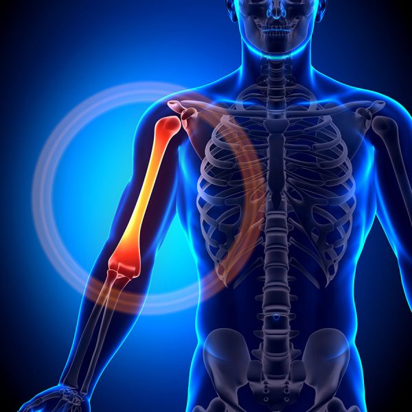 Upper arm pain Causes, Symptoms, Upper arm Injuries Physio Pretoria