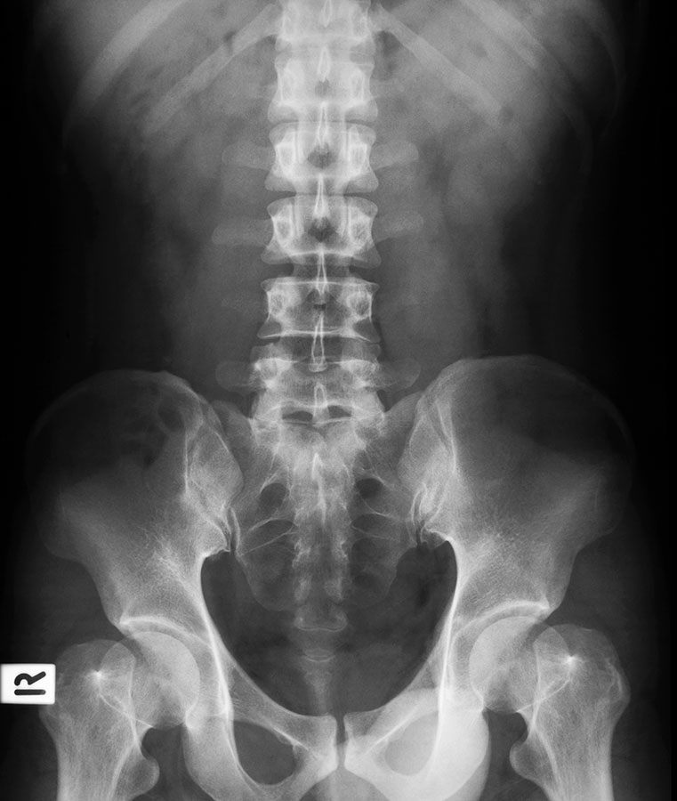 X-ray of Lower Back (Lumbar spine L1-S5) and both hips Scoliosis X-ray