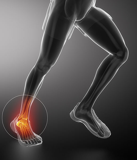 Physical Therapy for Ankle Sprains - Jaco Rehab