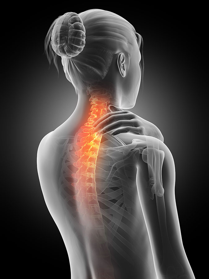 Pinched Nerve in Neck or Back