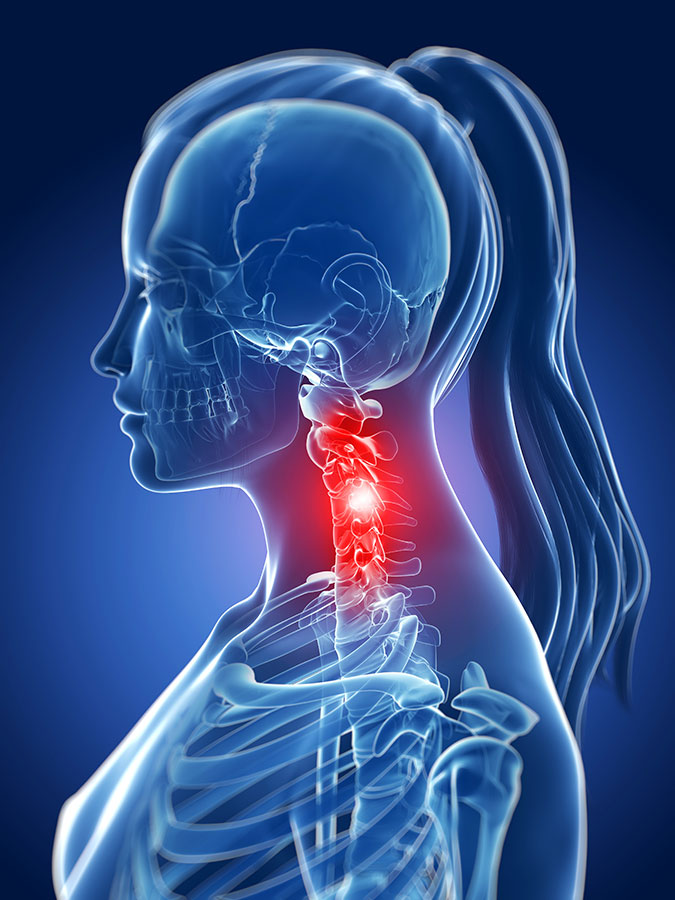 Pinched nerve in Neck, Neck joint degeneration, Neck joint pain, Painfull neck, Stiff neck joints