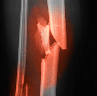 Bone fractures, Collar bone fracture, Types of fractures, Bone injury, Broken bone