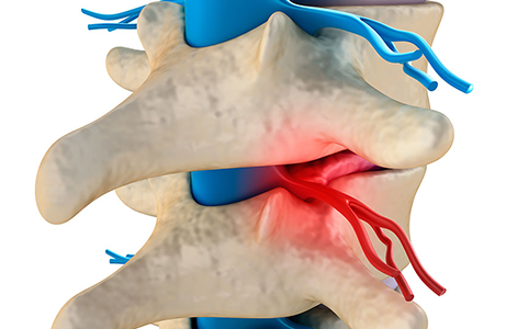 Sciatic nerve pain, Pinched sciatic nerve, Sciatic nerve injury, Sciatic nerve compression, Sciatic nerve irritation