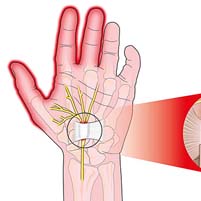 Carpal Tunnel Syndrome: Wrist nerve pain & Median nerve pain explained