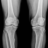 Total Knee Replacement, Total knee replacement rehabilitation, knee replacement treatment, total knee replacement exercises, knee replacement physio