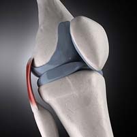 Lateral Collateral Ligament injury, Lateral Collateral Ligament tear, Lateral Collateral Ligament sprain, Knee LCL injury, Outside knee ligament injury