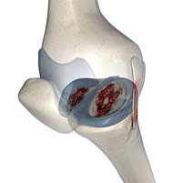 Self Tests for a Meniscus tear - Torn Knee meniscus? Get treatment today