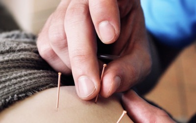 Demonstration of physiotherapy treatment called Acupuncture