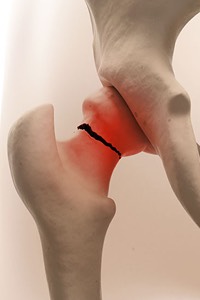 Hip fractures injury